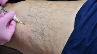 Allure Vein Center Sclerotherapy Spider Vein Treatment [upl. by Notlek439]