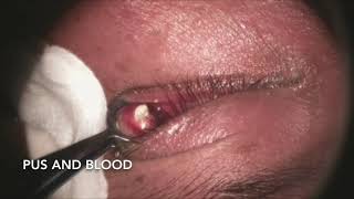 Incision and Drainage of Chalazion [upl. by Beitz171]