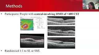 CME  Update on Medical Retina Talks by Dr Mahesh G Dr Noemi Lois [upl. by Julita]