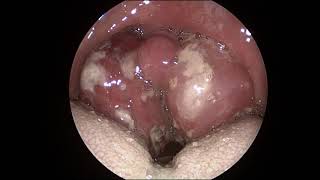 Acute Tonsillitis [upl. by Imtiaz]