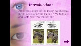 Therapies to cure Amblyopia [upl. by Rye]