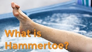 To Your Health Quick Takes What is Hammertoe [upl. by Okeim]