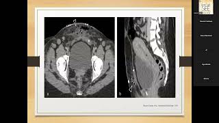 Postpartum obstetric complication Dr Eman Montaser Dr Ffatemazahraa DEnewar [upl. by Ennairrek]