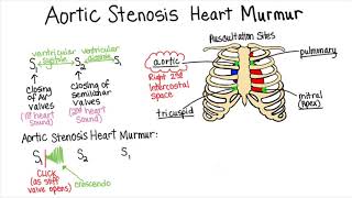 Aortic Stenosis  Part 2 Heart Murmur Series [upl. by Fionna]