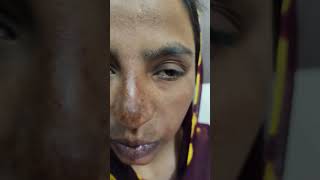 Melasma Chloasma Treatment Dr Ahsan Ahmad Skin Care Clinic Call 91 7417928805 [upl. by Sharyl631]