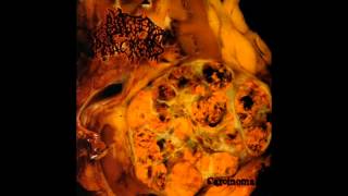 Blasted Pancreas  Carcinoma FULL ALBUM 2011  Pathological Goregrind [upl. by Anallij215]