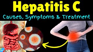 Hepatitis C – Symptoms Causes Pathophysiology Diagnosis Treatment Complications [upl. by Nnylorac978]