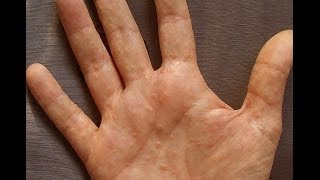 Dermatitis or Dyshidrosis How I Prevent Getting Painful And Unsightly Summer Hands [upl. by Seravart724]