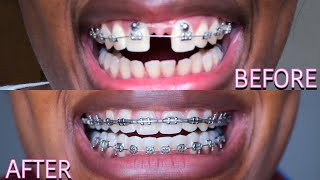 Full Braces Journey Time Lapse  3 Years Gaps Overbite Frenectomy  Starring Shameka [upl. by Onairelav]