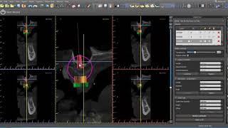 Designing maxillary implant supported overdenture [upl. by Etnomal]