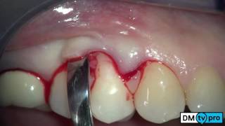 Single gingival recession treatment with Mucograft matrix [upl. by Phelgon]