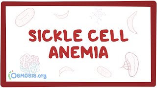 Sickle cell anemia  causes symptoms diagnosis treatment amp pathology [upl. by Vincenty]