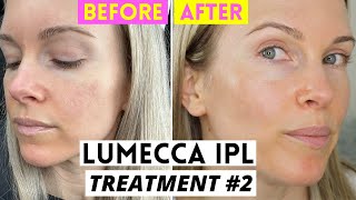 LUMECCA IPL BEFORE amp AFTER  TREATMENT 2 [upl. by Abell]