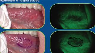 How do I check for Oral Cancer [upl. by Averir]