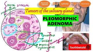 Pleomorphic Adenoma  Salivary gland tumors  DETAILED Textbook discussion Shafers  NEET MDSNBDE [upl. by Meuse]