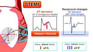 Ischemia 67  STEMI on ECG [upl. by Maurie]