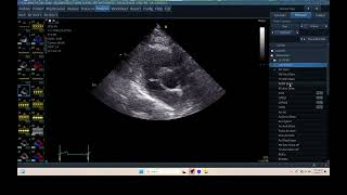 IQ 305 HEMODYNAMIC ECHOCARDIOGRAPHY ECHOPAC ANALYSIS [upl. by Yelmene]