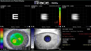 Ray Tracing Aberrometry  Dr Saud Javed [upl. by Zeb]