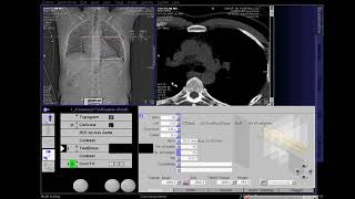 CT Coronary Angio Full Work Process SIEMENS in syngo acquisition workplace [upl. by Pearlman601]