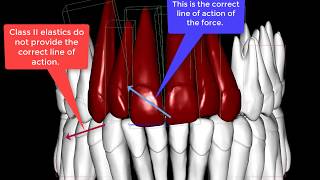 Midline correction from the posterior teeth [upl. by Latea35]