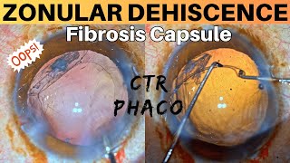 Zonular Dehiscence Noted during Phacoemulsification Management strategies  Dr Deepak Megur [upl. by Einhoj857]