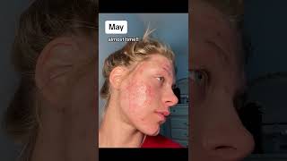 One year of acne scar progress in under 7 seconds acne skincare [upl. by Standish98]