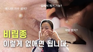 eng 비립종 나만 유독 잘 생기는 이유 집에서 제거 가능✨제거방법  피부과전문의 [upl. by Eceerahs394]