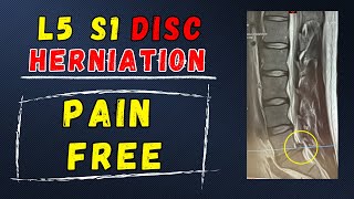 L5 S1 Disc Herniation Recovery without surgery [upl. by Anafetse]