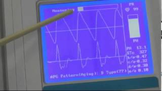 Meridian Digital Pulsewave Analyzer 1 Minute PTG amp Printout [upl. by Noeruat190]