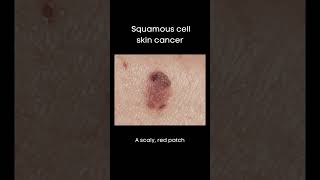 What do basal cell and squamous cell skin cancers look like [upl. by Triny]