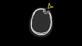 Head CT Depressed Skull Fracture Le Forte Fractures [upl. by Karry]