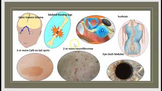 Neurofibromatosis types NF1 NF2 Causes Signs Symptoms Treatment Schwannomatosis 3 minutes [upl. by Arodal147]