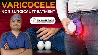 Varicocele Embolization By Dr Lalit Garg Nonsurgical Treatment For Varicocele [upl. by Keraj]