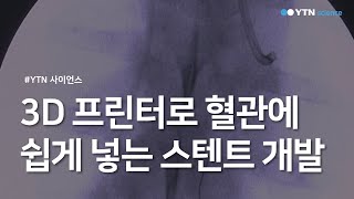 3D 프린터로 혈관에 쉽게 넣는 스텐트 개발  YTN 사이언스 [upl. by Church]