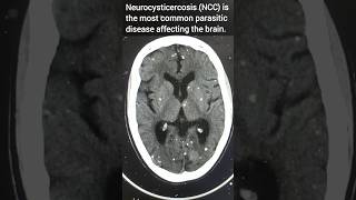 Neurocysticercosis l NCC l Stary ⭐ appearance in the brain neuroradiology radiology shorts [upl. by Eiclek]