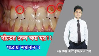 দাঁতের মাড়ি ক্ষয় রোধ করার ঘরোয়া উপায়Home remedies to prevent tooth decayস্বাস্থ্যসেবা [upl. by Yotal490]