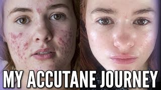 My Accutane Journey with Progress Photos and Relapse Experience [upl. by Harias]