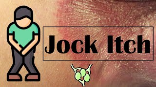 Jock Itch Treatment Prevention Causes and Home Care Tips [upl. by Chenay]