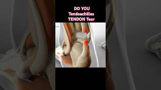 Learn about Tendon Tear tips foryou exercises physiotherapy physiotherapist doctor heelpain [upl. by Estell]