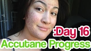 Day 16 Accutane SEVERE Acne Update WORKING FAST [upl. by Ennovahs]