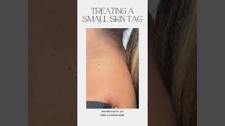 Treating a small skin tag using ThermoClear machine [upl. by Aihsatsan]