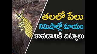 How to remove lice from hair at home in telugu  Thalalo pelu povalante em cheyali  తలలో పేలు [upl. by Sunday]