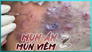 Big Cystic Acne Blackheads Extraction Blackheads amp Milia Whiteheads Removal Pimple Popping [upl. by Yeclek265]