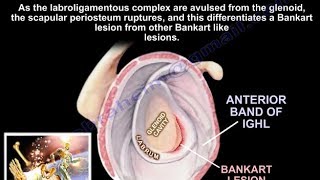 Lesions Of The Shoulder Bankart Lesion  Everything You Need To Know  Dr Nabil Ebraheim [upl. by Lefton]