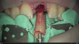 Dental Excellence 17 Root Extraction System [upl. by Buehler]