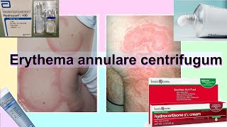 erythema annulare centrifugum [upl. by Ivgnout215]