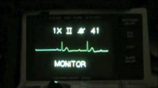 Vital Ethics ACLS ECG Recognition Sacramento [upl. by Artied]