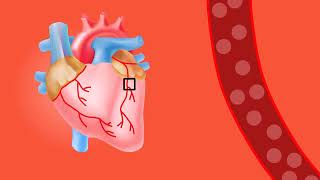 MI Myocardial Infarction Animation Video [upl. by Errol121]