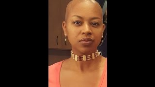 My Hair Journey with Scarring Alopecia [upl. by Hannus]