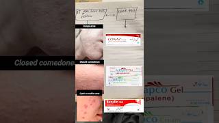 Best creams For Fungal AcneClosed comedones Cystic or Nodular Acneskincare medicine shortvideo [upl. by Oznole726]